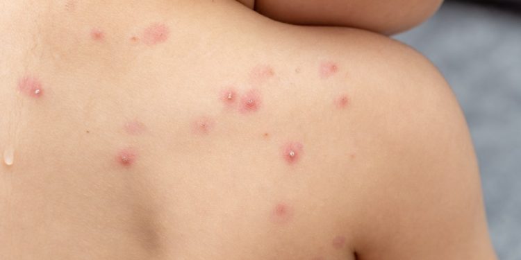 OMS: varíola dos macacos é declarada como emergência de saúde global